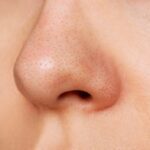 جوش های سرسیاه روی بینی