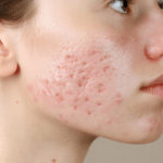 چه چیزی باعث ایجاد اسکار آکنه می شود