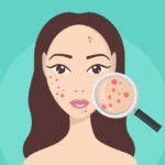 چگونه یک جوش بزرگ را که از بین نمی رود، درمان کنیم