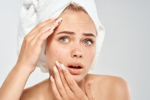 نحوه درمان لکه های تیره روی صورت (ملاسما)