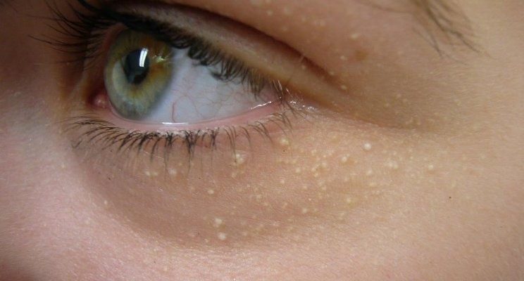 آن جوش های ریز سفید روی صورت شما چیست؟
