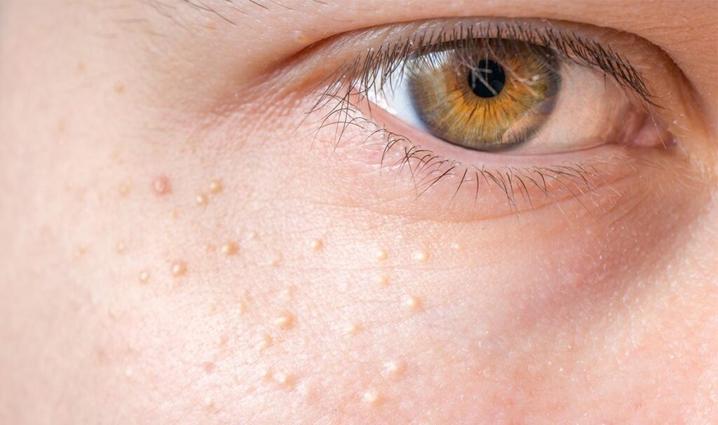 آن جوش های ریز سفید روی صورت شما چیست؟