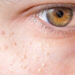 آن جوش های ریز سفید روی صورت شما چیست؟