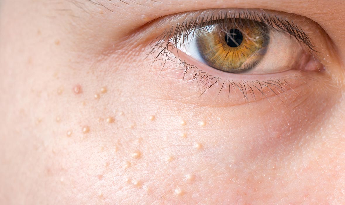 آن جوش های ریز سفید روی صورت شما چیست؟